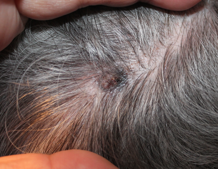 scalp bump concerns